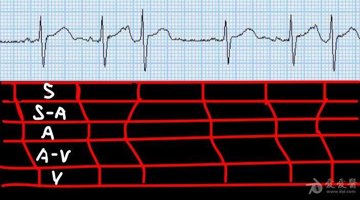 异常波出现的方式_非特异性t波异常有问题吗_异常波发作期间