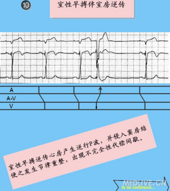 心室扑动室性心动过速_阵发性心房扑动的治疗_阵发性室上性心动过扑