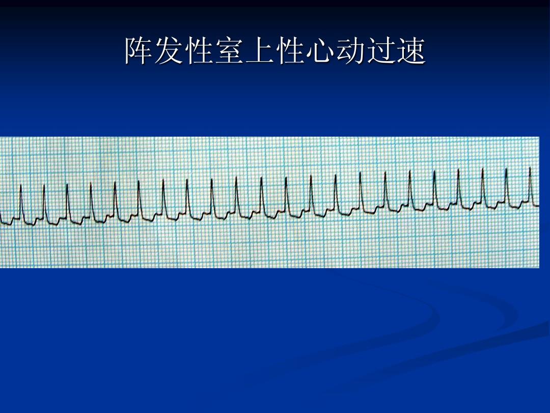 阵发性心房扑动吃什么药_阵发性室上性心动过扑_心室扑动室性心动过速