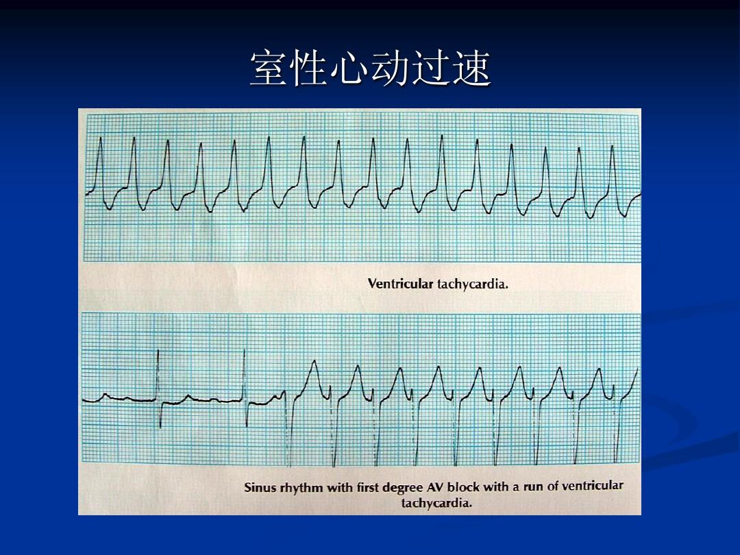 阵发性心房扑动的治疗_阵发心房扑动_阵发性室上性心动过扑